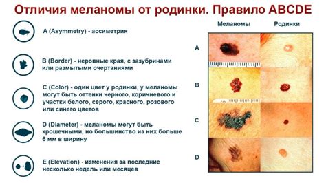 Как определить опасность родинки на ключице