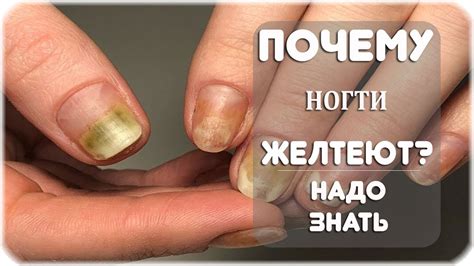 Почему желтеют