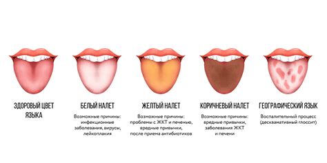 Причины уплотнения на языке
