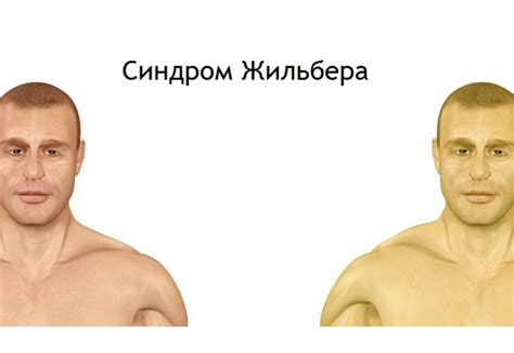 Проявления и лечение синдрома Жильбера