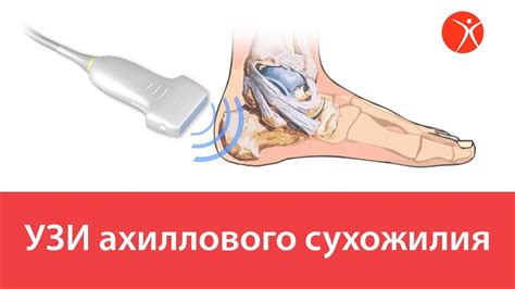 Психологическая поддержка в лечении укороченного ахиллова сухожилия