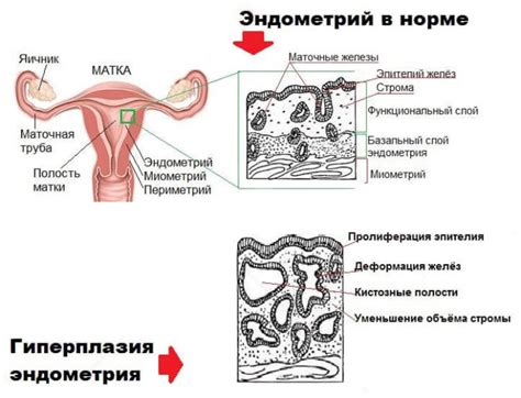 Эндометриальная гиперплазия в менопаузе