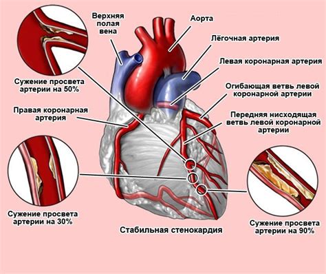 Виды стенокардии и их симптомы