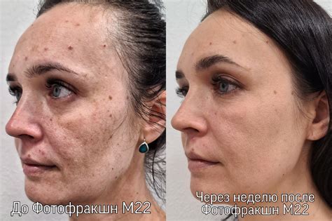 Влияние гормонов на меланиновый пигмент