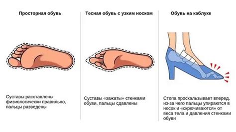 Влияние неправильной обуви на механику ходьбы