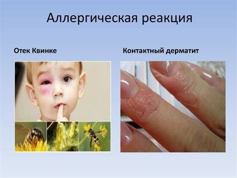 Возможные аллергические реакции: