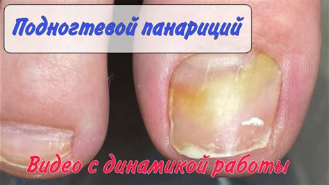 Возможные причины пенения перекиси водорода под ногтем