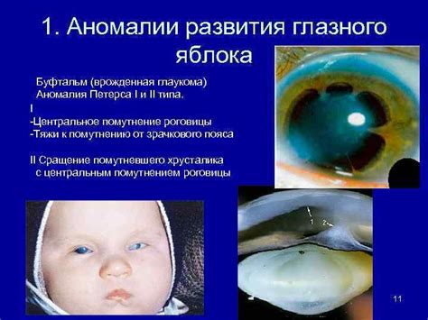 Врожденная аномалия глазного аппарата