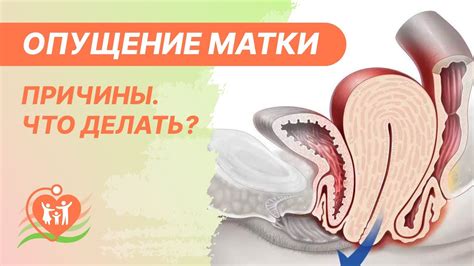 Выпадение матки