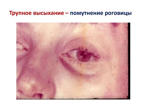 Высыхание слизистых оболочек в носу и горле: