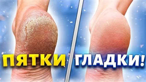 Гладкая кожа и бархатистые пятки