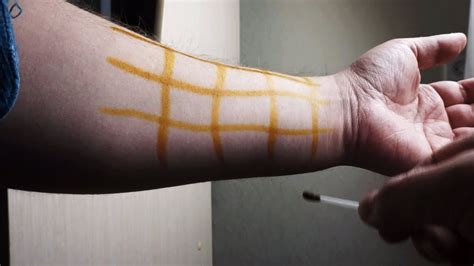 История использования йодовой сетки в медицине