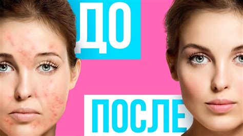 Как предотвратить появление прыщей после приема витаминов