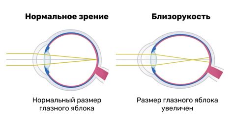 Миопия и ограничения