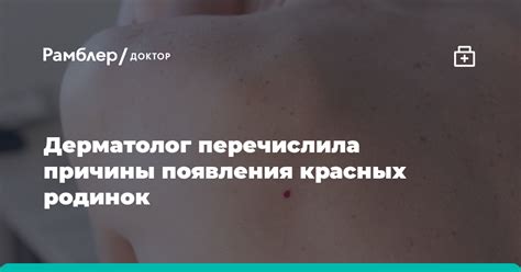 Миф или реальность: прижигание красных родинок