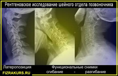 Нарушение шейного отдела позвоночника