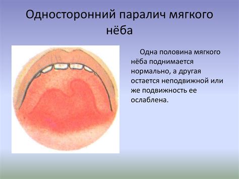 Неадекватные размеры гортани и мягкого нёба