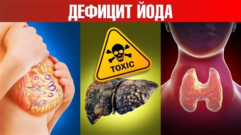 Негативные последствия воздействия йода на организм