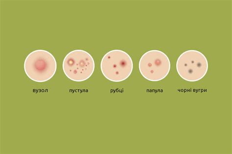 Осложнения и последствия от выдавливания прыщей под мышкой