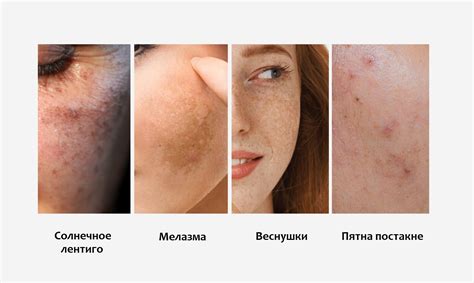 Особенности пигментации и количества меланина