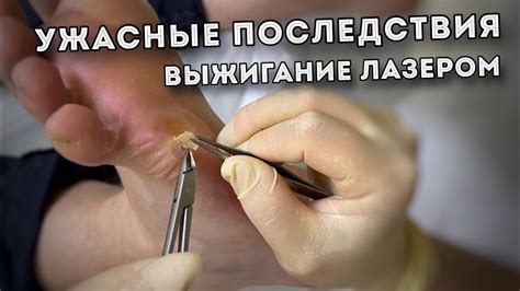 Отучивание от удаления