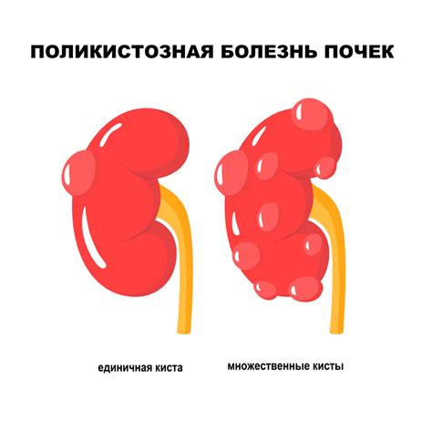 Перегруженность почек