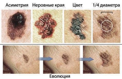 Популярные методы удаления родинок