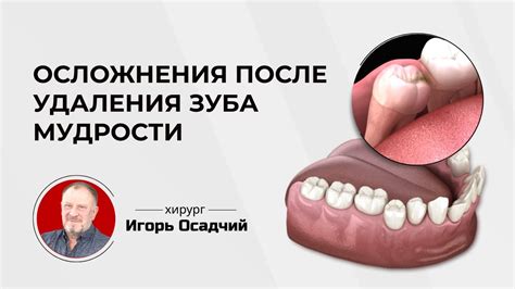 Последствия удаления майка Россы