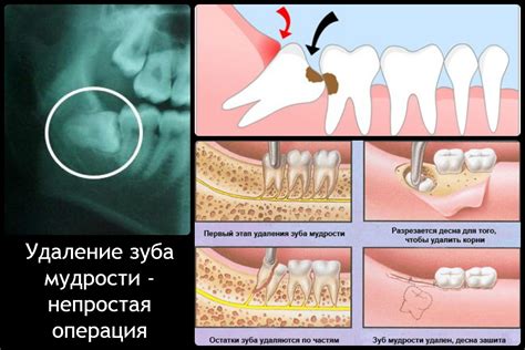 Последствия удаления механизмов из расценки