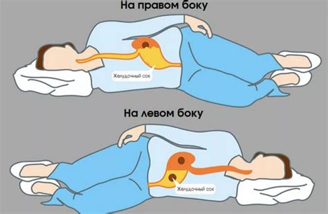 Почему возникает тошнота в горизонтальном положении на левом боку