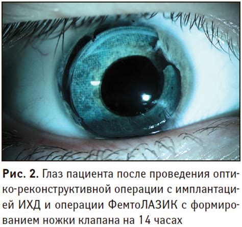 Почему производят заклеивание глаз пациента при операции