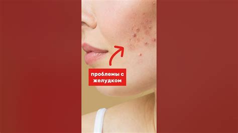 Почему прыщ выделяет прозрачную жидкость: причины и способы решения