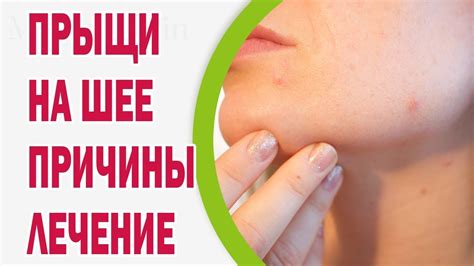 Причины возникновения засосов на шее у мужчин