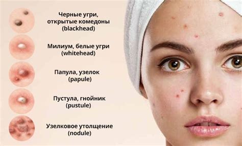 Причины образования прыщей