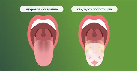 Причины раздражения слизистой горла