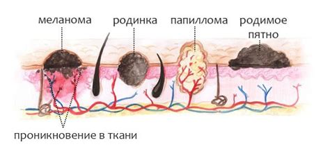 Причины формирования наростов