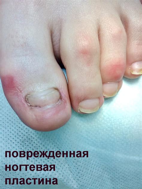 Проблемы с петлевидной пластиной