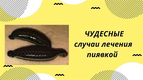 Происхождение мифа о пиявках на жировик