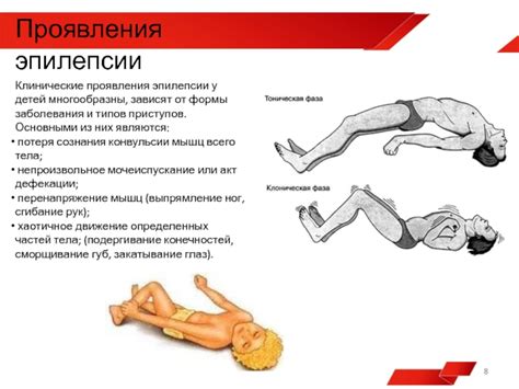 Проявления эпилепсии у детей