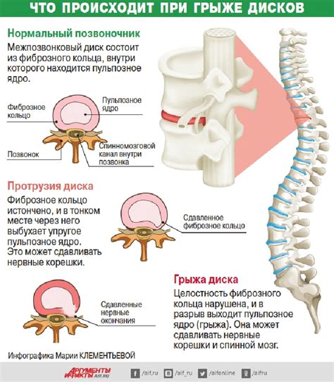 Раздел 1: Определение и причины грыжи позвоночника
