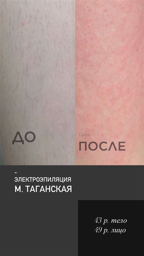 Результаты обкапывания