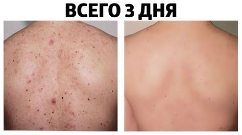 Рекомендации по уходу за прыщами под мышкой