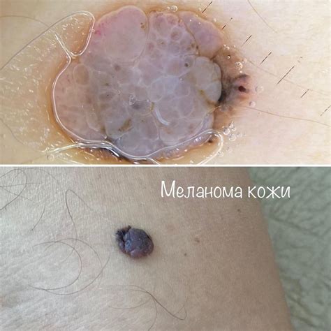Риск при удалении родинок самостоятельно