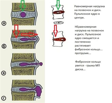 Роль антидепрессантов при болях в позвоночнике
