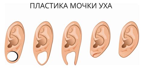 Что такое сросшаяся мочка уха