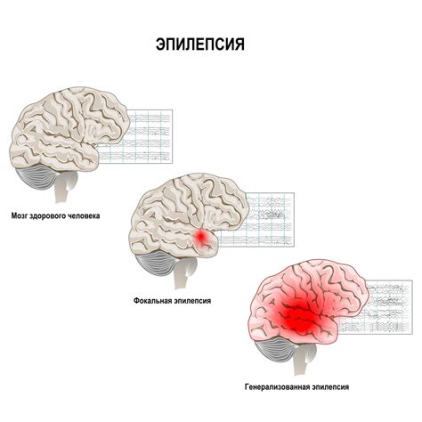 Эпилепсия у детей: основные симптомы и причины