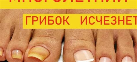 Эффективные методы лечения косточек на ногах с использованием йода