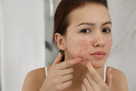 Эффективные методы лечения прыщей